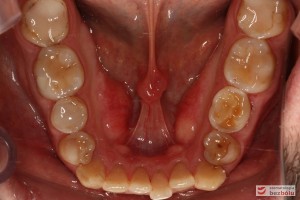 Żuchwa - widok okluzyjny, stłoczenia i rotacje w odcinku przednim, ząb mleczny po stronie lewej