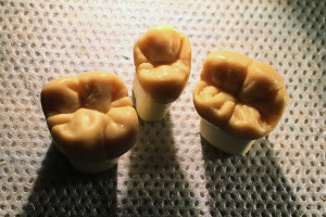 Sztuka modelowania w stomatologii - wyrzeźbione korony zębów