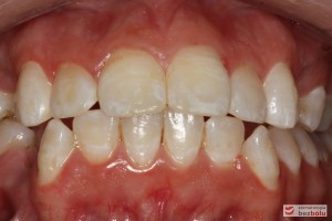 Warunki zgryzowe przed leczeniem (dokonano już ekstrakcji dolnej czwórki) Warunki zgryzowe przed leczeniem (dokonano już ekstrakcji dolnej czwórki)