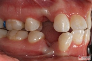 Warunki zgryzowe - strona prawa (widoczna dokonana ekstrakcja dolnej i górnej czwórki) Warunki zgryzowe - strona prawa (widoczna dokonana ekstrakcja dolnej i górnej czwórki)