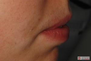 Profil pacjentki przed leczeniem - widoczna niekompetencja warg Profil pacjentki przed leczeniem - widoczna niekompetencja warg
