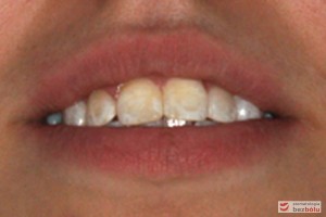 Nadmierne wychylenie zębów siecznych górnych