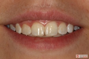 Uśmiech pacjentki po leczeniu Uśmiech pacjentki po leczeniu