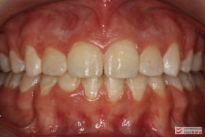 Warunki zgryzowe po leczeniu Warunki zgryzowe po leczeniu