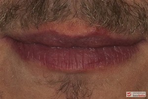 Dolny odcinek twarzy - usta zamknięte symetryczne