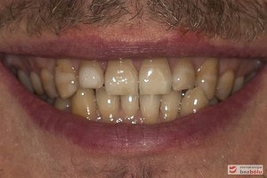 Uśmiech pacjenta - ekspozycja dziąsła w strefach bocznych, za długie zęby dolne przednie