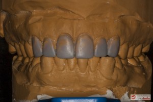 Modele gipsowe w artykulatorze - nawoskowane zęby od kła do kła w celu ich wydłużenia