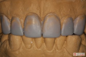 Modele gipsowe w artykulatorze - nawoskowane zęby od kła do kła w celu ich wydłużenia
