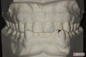 Ortodontyczne modele diagnostyczne - dla wykonania obliczeń wielkości i kształtu zębów