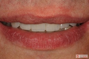 Uśmiech w spoczynku - wydłużone zęby sieczne i skrócone kły