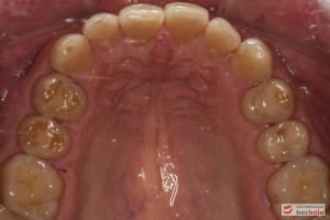 Szczęka - widok okluzyjny - rekonstrukcje kompozytowe w zębach bocznych