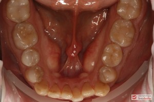 Powierzchnia okluzyjna w żuchwie - rekonstrukcje kompozytowe w zębach bocznych