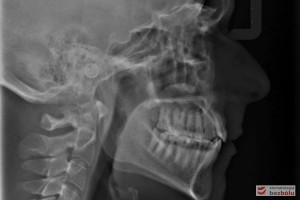 Diagnostyka cefalometryczna - ocena położenia szczęk i zębów względem siebie