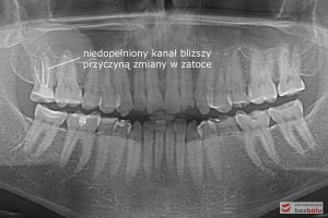 Diagnostyka radiologiczna - przetrwały ząb mleczny w żuchwie, brak zawiązka stałego