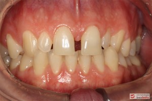 Warunki zgryzowe przed leczeniem Warunki zgryzowe przed leczeniem