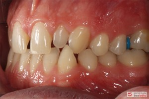 Warunki zgryzowe przed leczeniem - strona lewa Warunki zgryzowe przed leczeniem - strona lewa