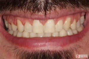 Uśmiech po leczeniu i wykonaniu wstępnej rekonstrukcji rudymentowanych siekaczy bocznych Uśmiech po leczeniu i wykonaniu wstępnej rekonstrukcji rudymentowanych siekaczy bocznych