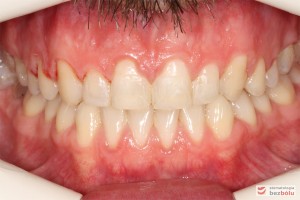 Warunki zgryzowe po leczeniu Warunki zgryzowe po leczeniu