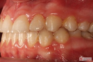 Warunki zgryzowe po leczeniu, strona lewa Warunki zgryzowe po leczeniu, strona lewa