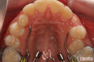 Zamontowany Rotator w szczęce Zamontowany Rotator w szczęce