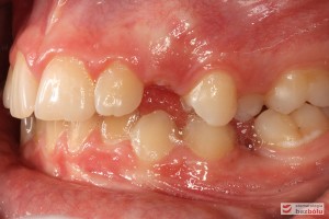 Warunki okluzyjne, strona lewa, przed leczeniem Warunki okluzyjne, strona lewa, przed leczeniem