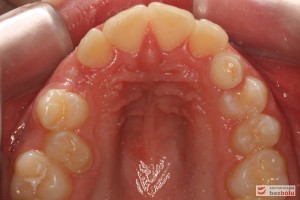 Widok od strony okluzyjnej, łuk górny Widok od strony okluzyjnej, łuk górny