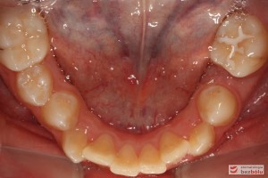 Widok od strony okluzyjnej, łuk dolny Widok od strony okluzyjnej, łuk dolny