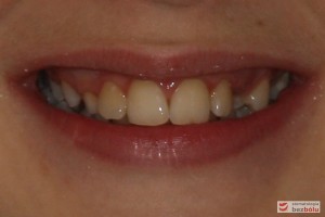 Uśmiech pacjenta przed leczeniem Uśmiech pacjenta przed leczeniem