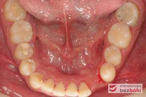 Widok powierzchni okluzyjnej zębów w żuchwie – pojedyncze braki zębowe