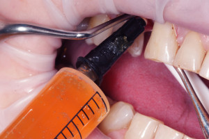 Płukanie łoża implantu osoczem