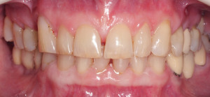 Sytuacja wewnątrzustna - widok od przodu. Zęby w maksymalnym