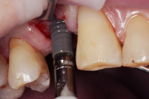 Wprowadzenie implantu