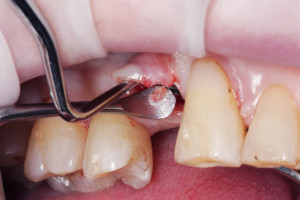 Wprowadzenie implantu