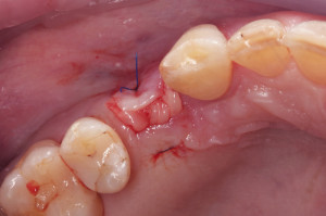 Stan po zeszyciu miejsca zabiegowego