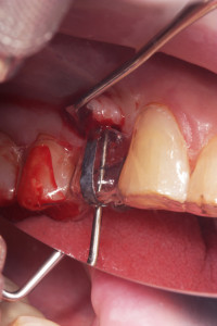 Kontrola położenia brzegu dodziąsłowego przyszłej korony według zasady 3A-2B