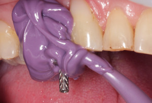 Pobieranie wycisku z transferem wyciskowym masą polieterową