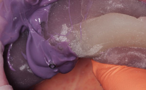 Pobieranie wycisku z transferem wyciskowym masą polieterową