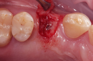 Odpreparowany płat śluzówkowo-okostnowy