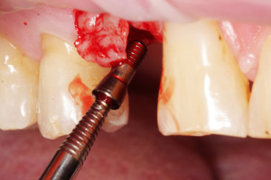 Wykręcenie śruby zakrywkowej