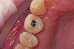 Korona pełnoceramiczna przykręcona do implantu przed zamknięciem kompozytem otworu na śrubę