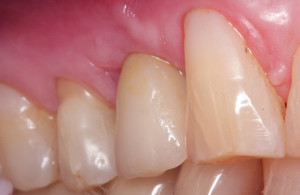 Sytuacja wewnątrzustna po zakńczonym leczeniu - widok od strony policzkowej