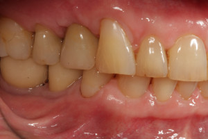 Sytuacja wewnątrzustna po zakńczonym leczeniu