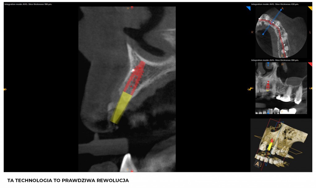 Wirtualnie planowane zagłębienie implantu