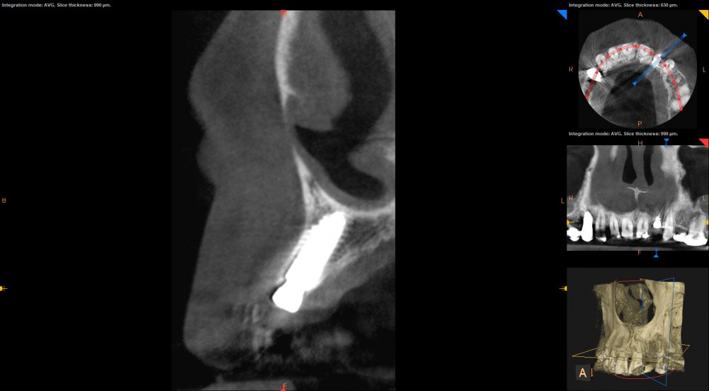 Wprowadzony do kości implant, dokładnie w wirtualnie zaplanowanej pozycji